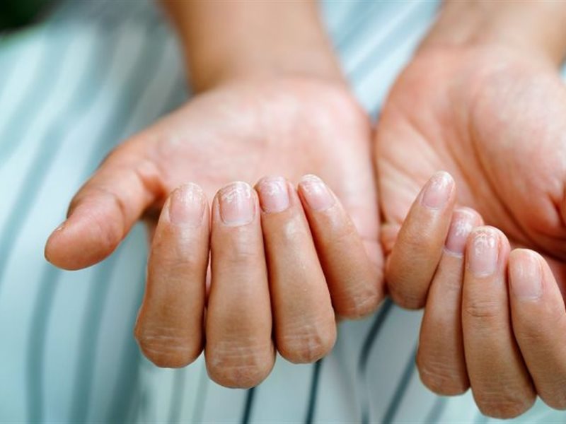 هل الأظافر الهشة علامة على نقص الفيتامينات أو المعادن؟