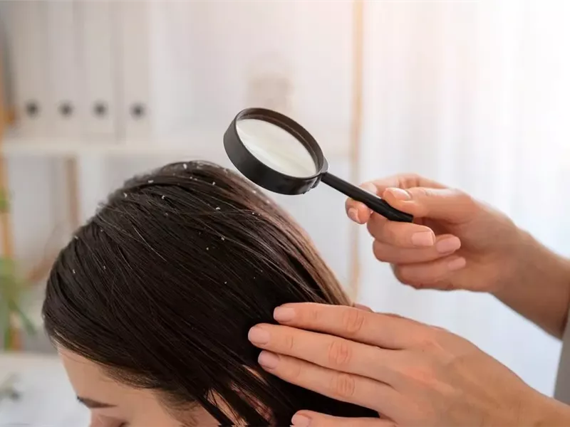 4 علاجات منزلية لقشرة الشعر.. تجنب هذه الوصفات