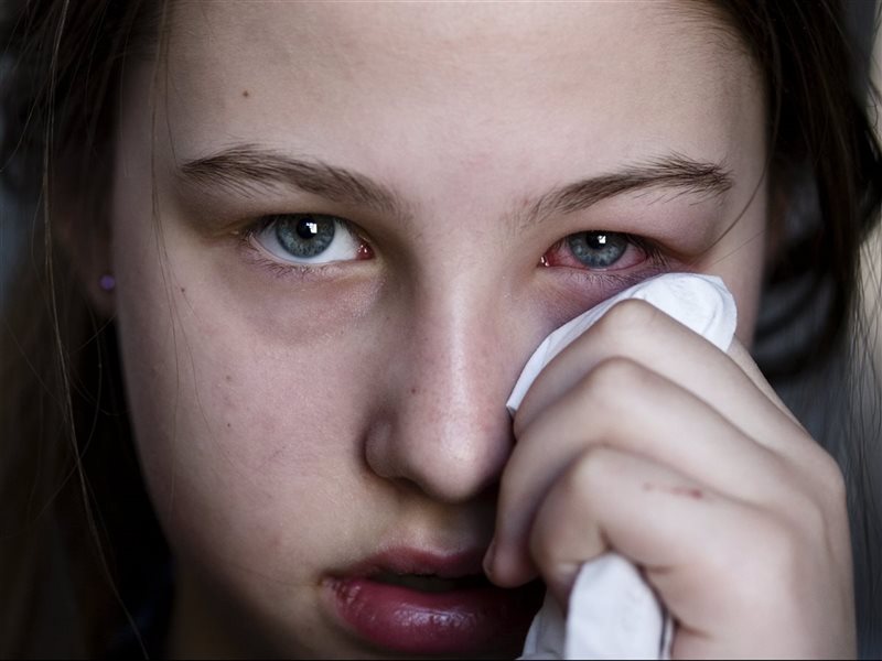  هل للحساسية دور في احمرار العين؟  