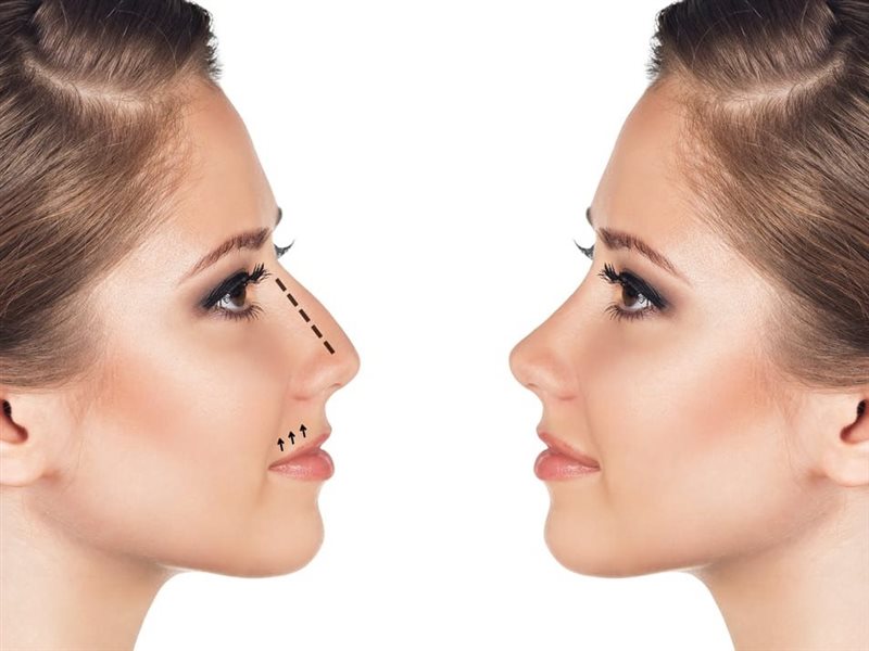 هل يمكن رفع طرف الأنف بدون جراحة تجميل؟ 