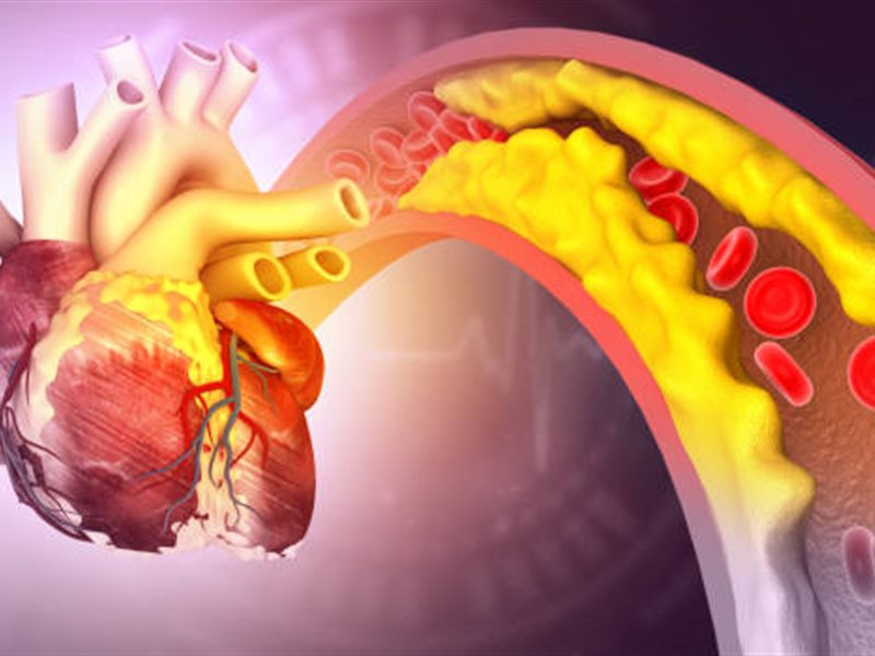 أسباب متعددة وراء تصلب الشرايين.. هل السمنة تلعب دور في ذلك؟ 