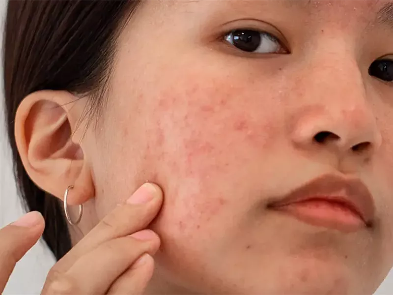 5 مشاكل جلدية قد تواجه المصابات بتكيس المبايض