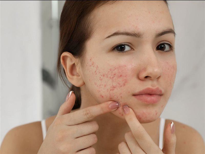 هل تعاني من حب الشباب؟.. 5 عادات تساعدك على منع ظهوره 