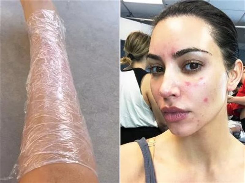 كيم كارداشيان تفتح قلبها حول معاناتها مع الصدفية وتكشف عن علاج غير تقليدي