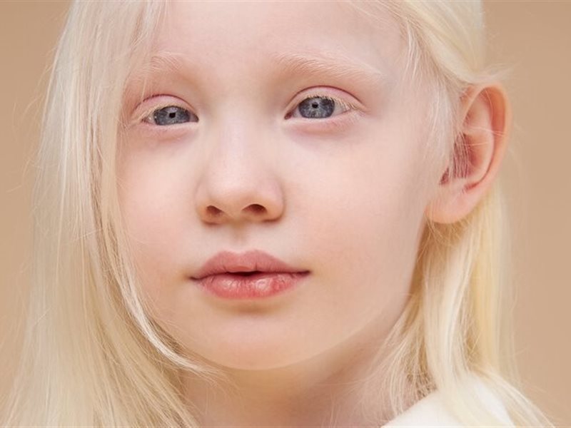 اليوم العالمي للمهق.. إليك أهم أسبابه وتأثيره على الشعر والعين والبشرة 