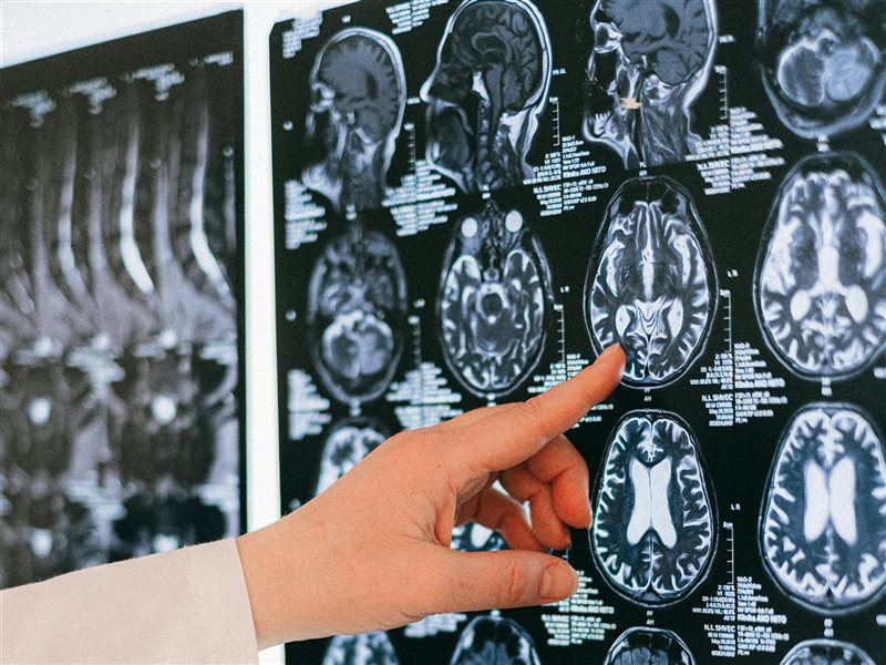 في الشهر العالمي لأمراض الدماغ.. دليلك للوقاية منها 