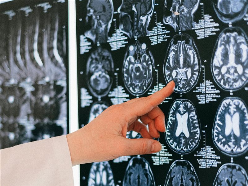 في الشهر العالمي لأمراض الدماغ.. تعرف على أبرز تلك الأمراض وأهم أعراضها 