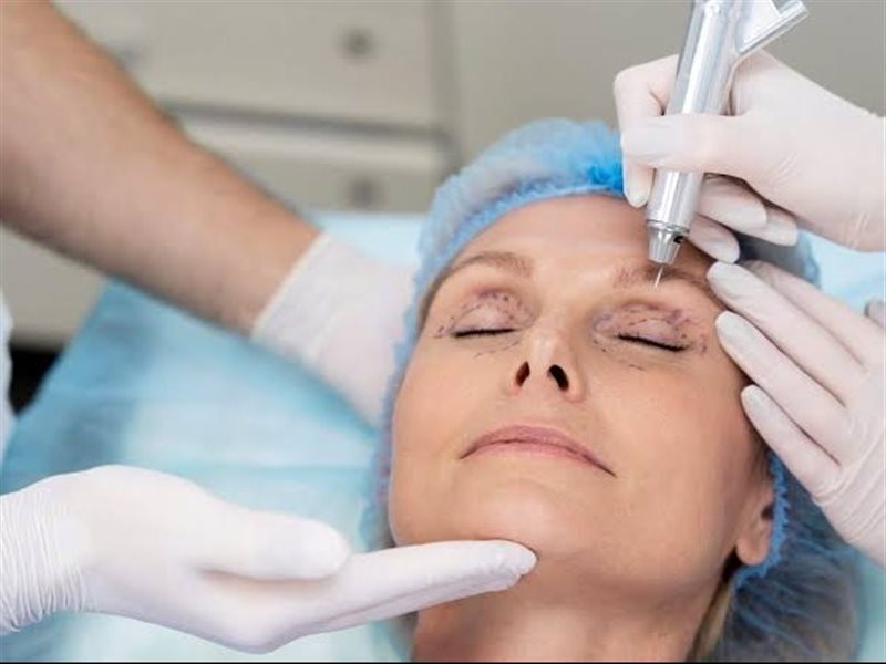 تقنية البلازماج.. حل غير جراحي لشد الجفون واستعادة شباب النظرة