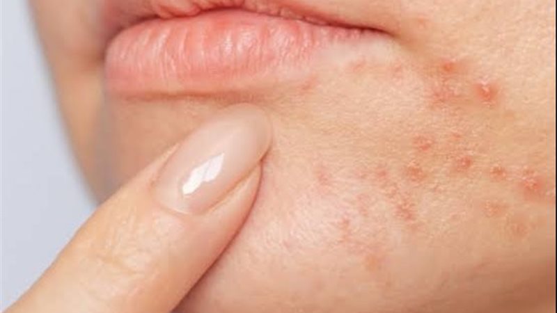 Perioral Dermatitis