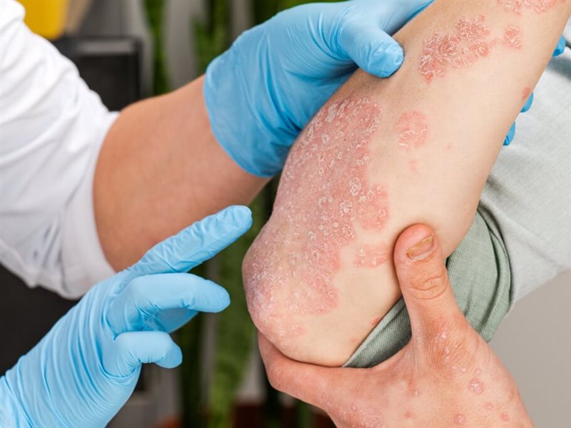 في الشهر العالمي للصدفية.. هل هذا المرض معدي؟