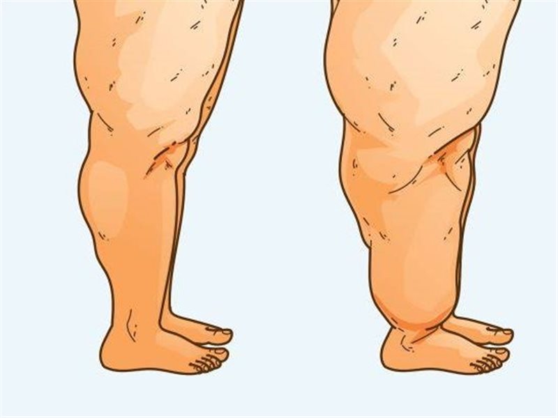 الليبيديما… اضطراب دهني يختبئ خلف السمنة ويؤثر على حياة النساء