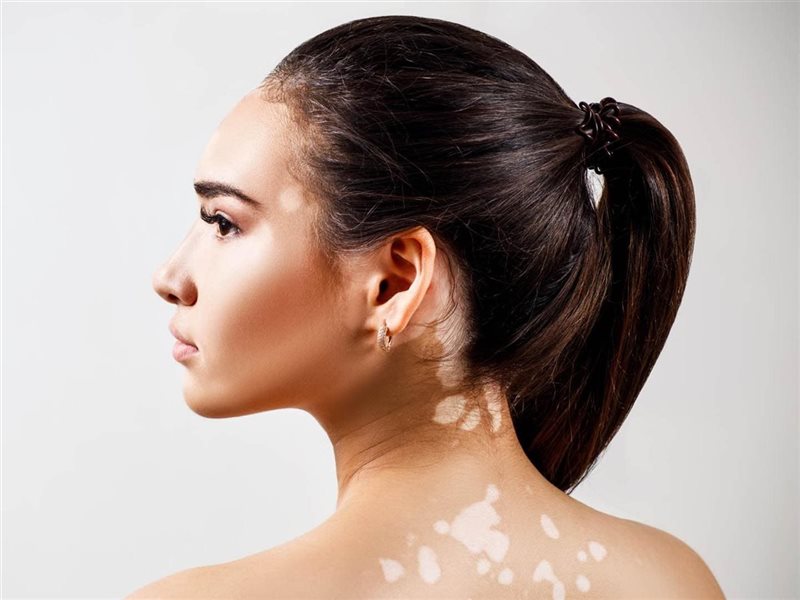  FDA توافق على أول علاج موضعي للبهاق يعيد تصبغ الجلد تدريجيًا 