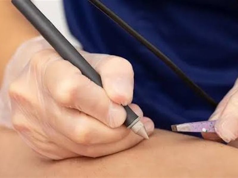  Electrolysis يتفوّق على الليزر: التقنية التي تمنحك نتائج دائمة لبشرة ناعمة