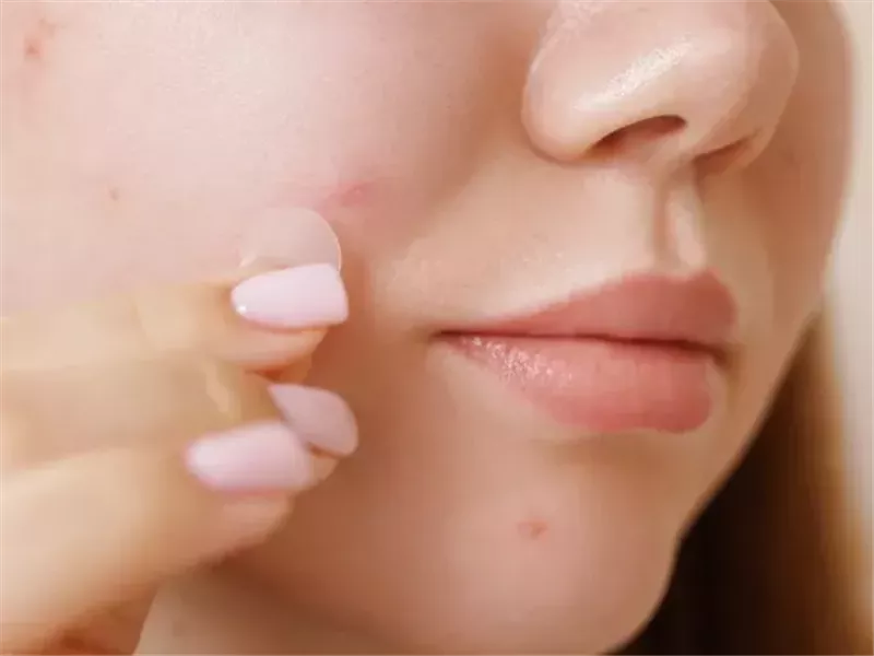 لاصقات حب الشباب.. وسيلة فعّالة لعلاج البثور وتسريع التئام الجلد