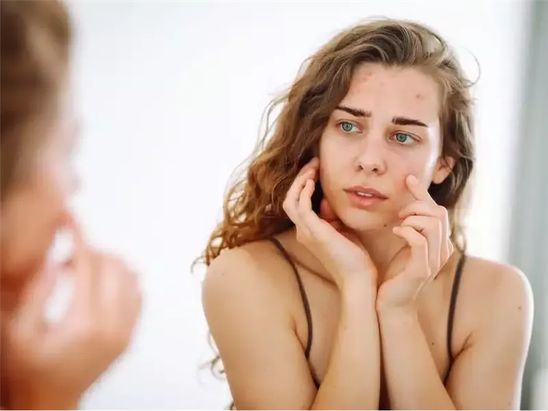 بشرتك معرضة لحب الشباب.. روتين العناية بالبشرة المناسب لك