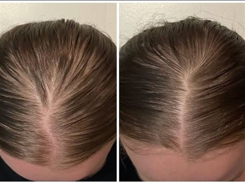  Oral Minoxidil صيحة جديدة في عالم العناية بالشعر