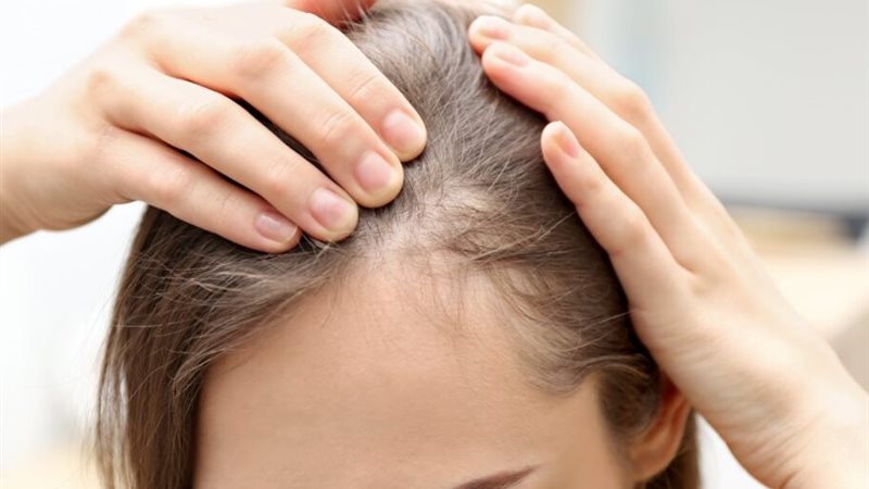 علاج تساقط الشعر