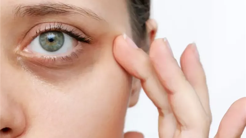 الهالات السوداء