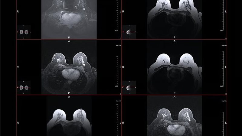 فحص الماموجرام